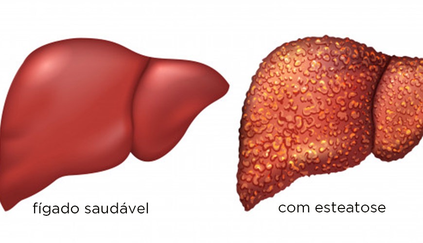 Esteatose Hepática A Doença Gordurosa do Fígado