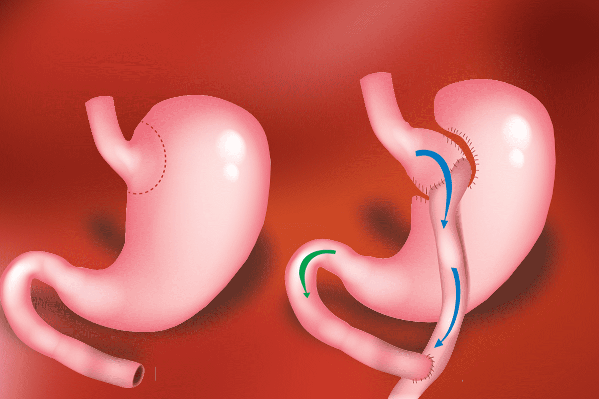 Cirurgia de Bypass Gástrico Cirurgia de Bypass Gástrico