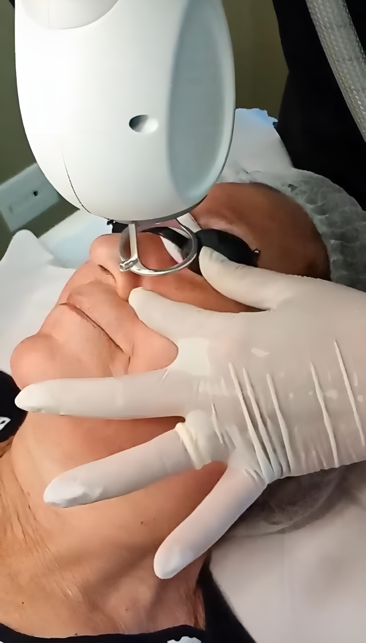 Lumiere: a nova geração do Laser de Thulium que revoluciona sua pele
