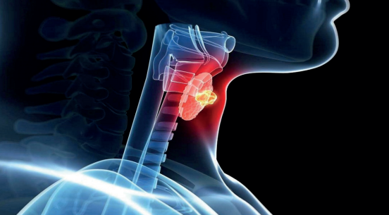 Cirurgia de laringe a laser: entenda mais sobre o procedimento!