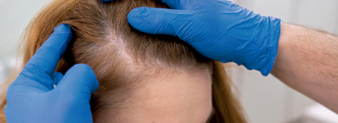 Transplante capilar para mulheres: uma opção cada vez mais frequente