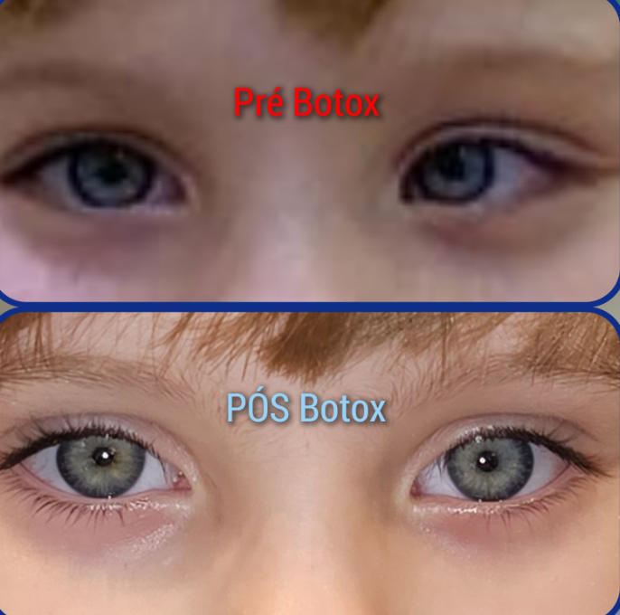 Estrabismo na Infância: Importância do Diagnóstico e Tratamento Precoce