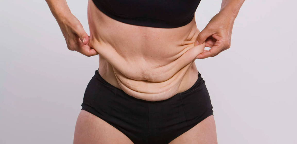 O Papel da Cirurgia Plástica na Reabilitação Pós Bariátrica