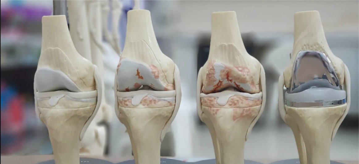 Personalização da Cirurgia Robótica no Joelho: Como a Tecnologia Melhora os Resultados