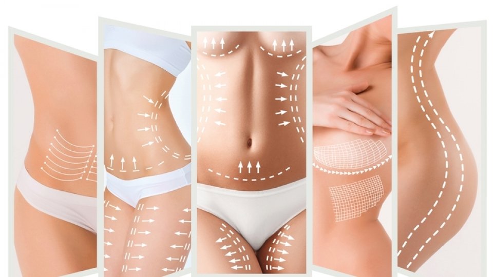 Lipoaspiração de Definição