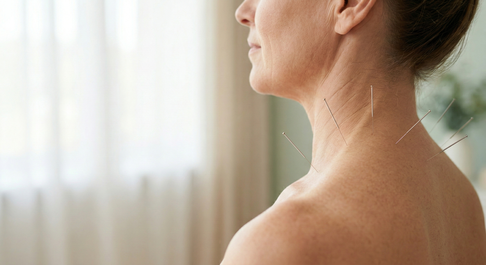 Acupuntura é Unanimidade no Tratamento da Fibromialgia