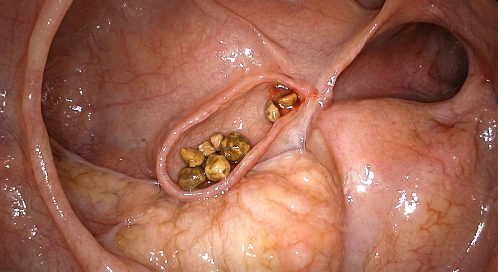 Pedra na Vesícula Sintomas e Tratamento Cirúrgico