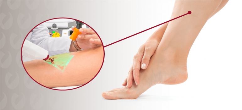 A Utilização do Laser no tratamento das varizes.