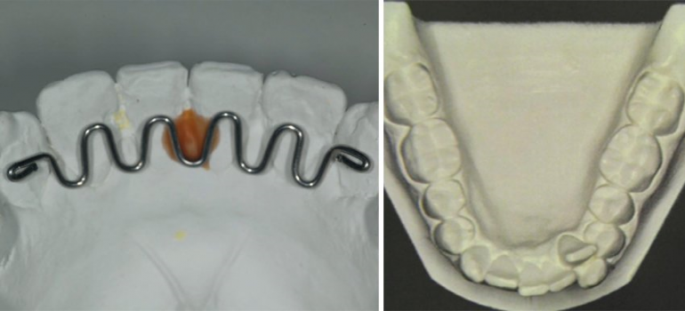 “Doutor, eu já usei aparelho, mas meus dentes voltaram a entortar!’