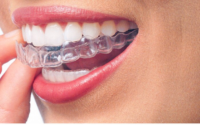 Invisalign® e a Mulher moderna