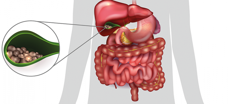Pedra na vesícula Sintomas e tratamento cirúrgico