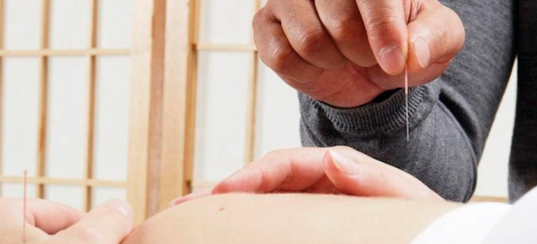 Acupuntura na gravidez