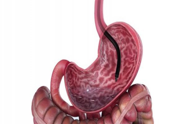 Emagrecimento por Endoscopia?