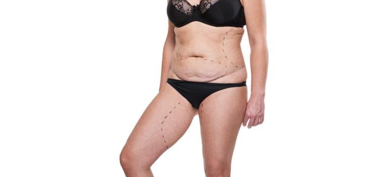 Cirurgia plástica após cirurgia bariátrica