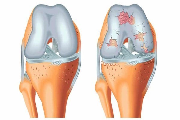 “Doutor, tenho problema de cartilagem!”