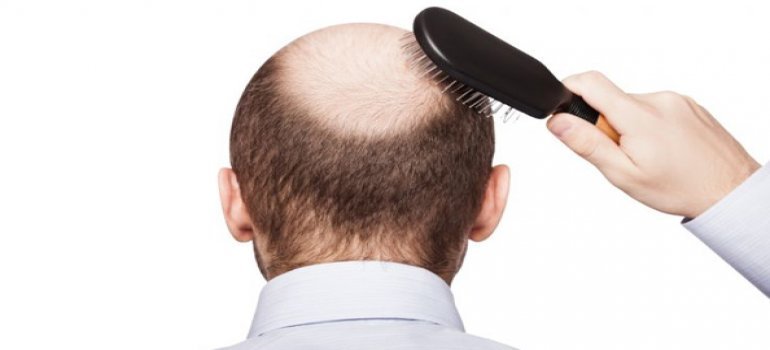 O COVID pode te deixar Calvo?