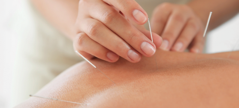 Os benefícios da Acupuntura no Tratamento da Ansiedade e Estresse.