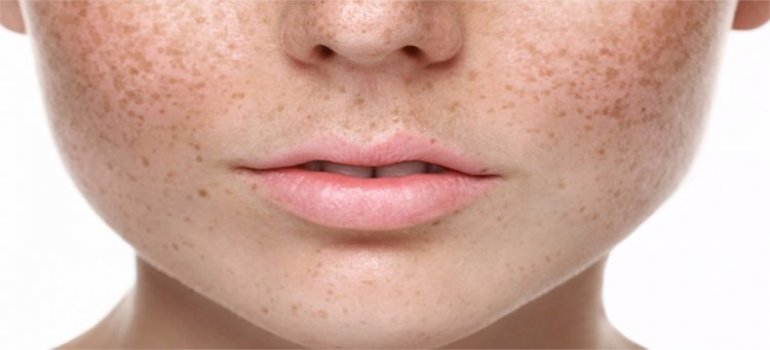 Novidades no Tratamento do Melasma