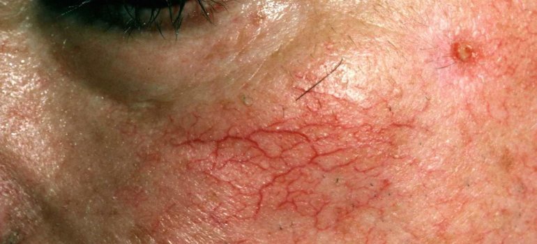 Laser para tratamento de Vasos e Vasinhos na Face