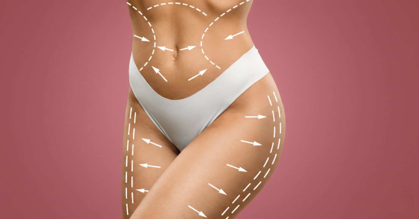 Você sabe a diferença entre lipoaspiração e lipoescultura?