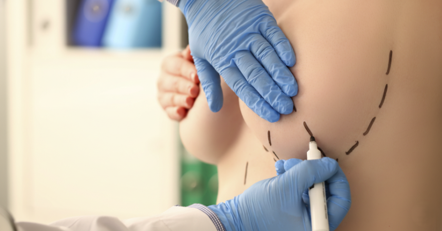 Cirurgias das Mamas: Quando estética e bem-estar caminham juntos