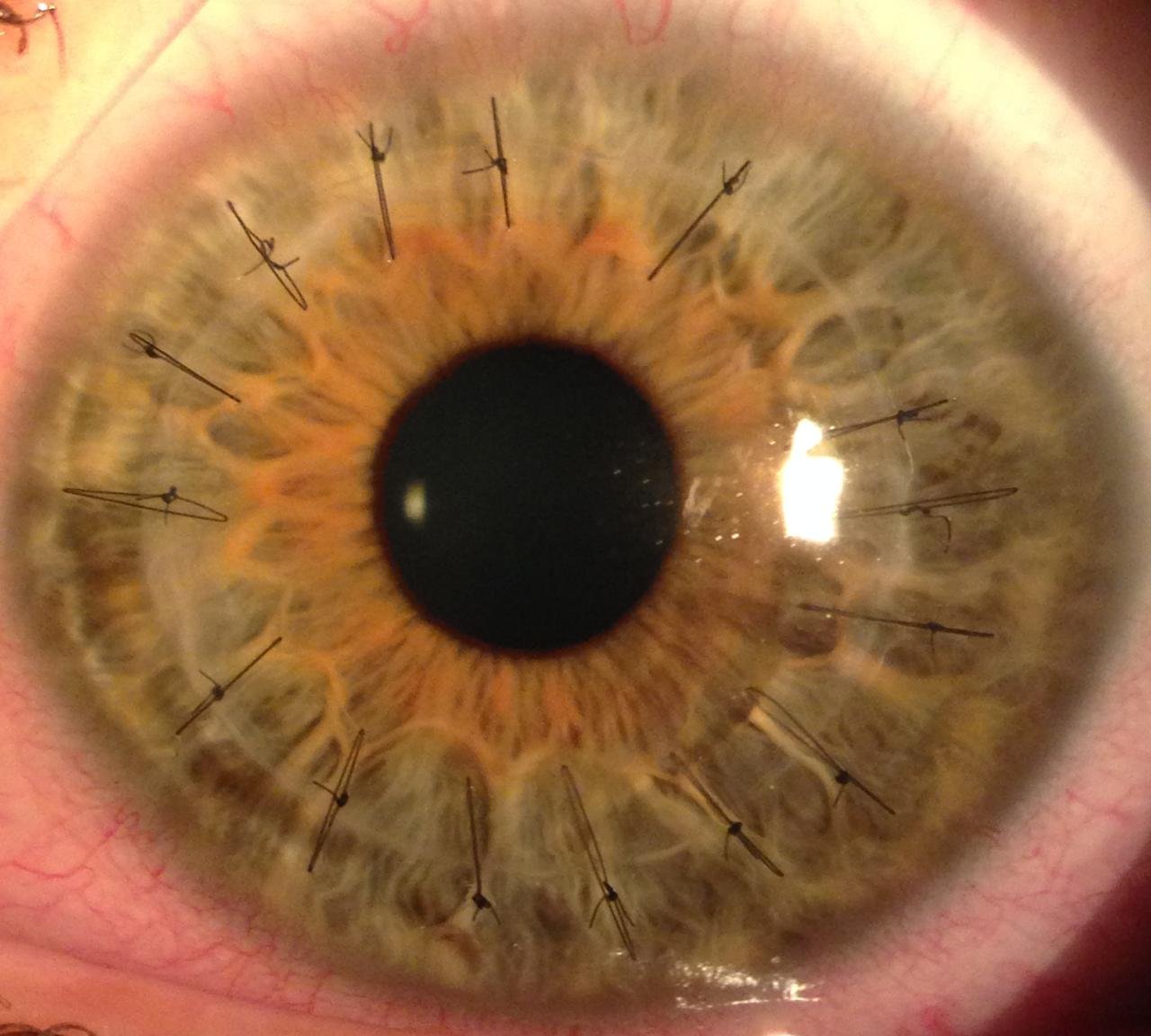 O uso de células endoteliais no lugar de transplante de córnea: o futuro pode reduzir drasticamente a fila de espera?