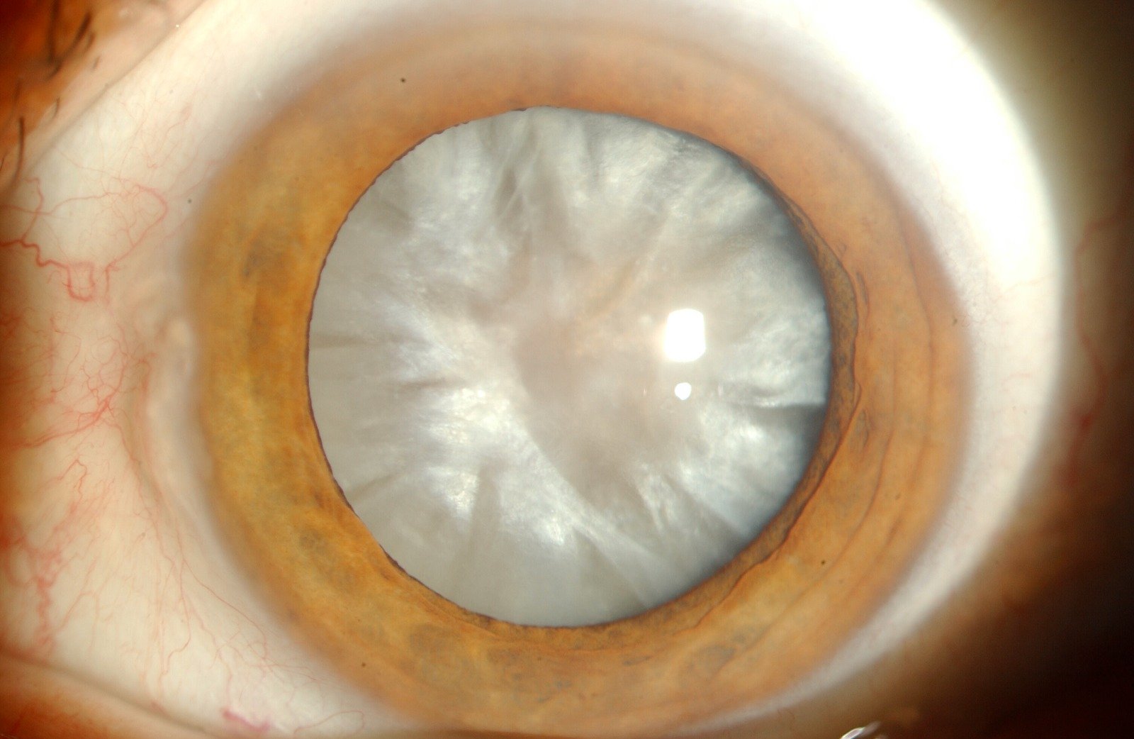 SELAGEM DA INCISÃO DA CATARATA COM COLA ORGÂNICA: DIFERENCIAL INCOMPARÁVEL PARA O RETORNO ÀS ATIVIDADES FÍSICAS JÁ NO PRIMEIRO DIA APÓS A CIRURGIA
