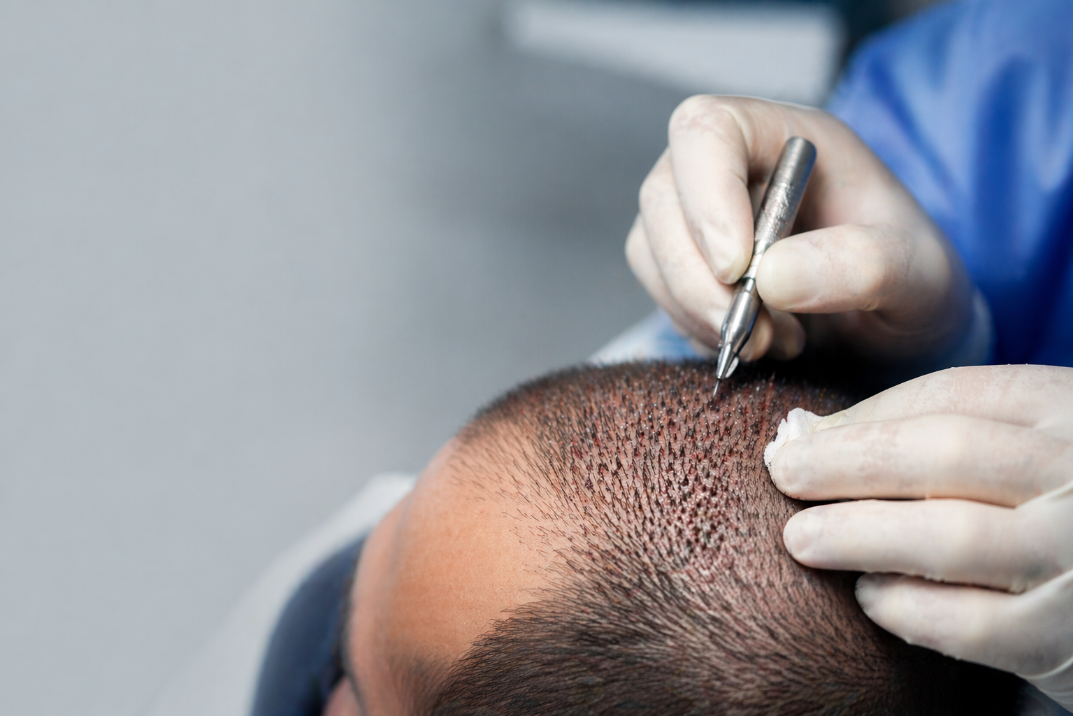 Transplante capilar pela técnica FUE: O que é, como funciona e para quem é indicado?