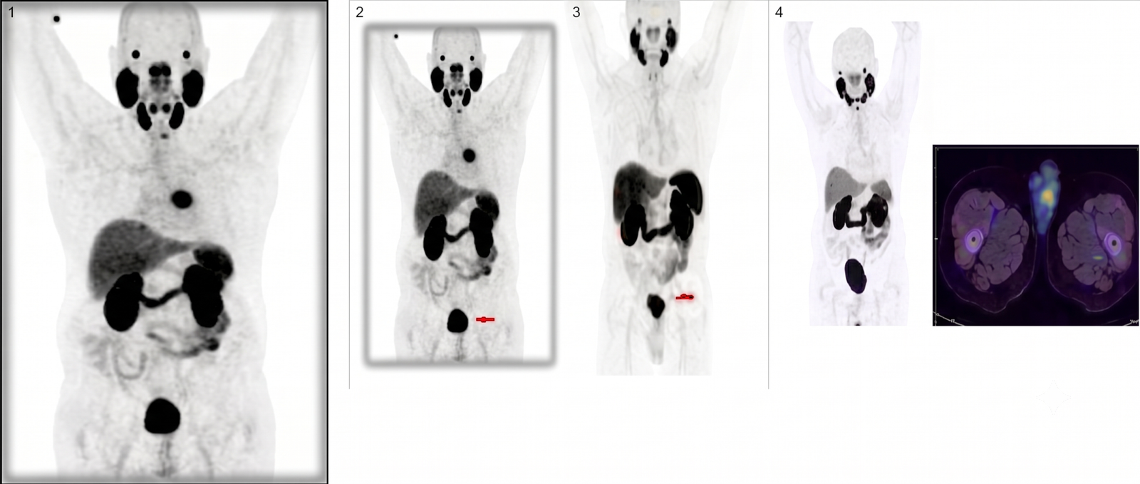 PET/CT com PSMA: Uma realidade crescente no manejo do câncer de próstata