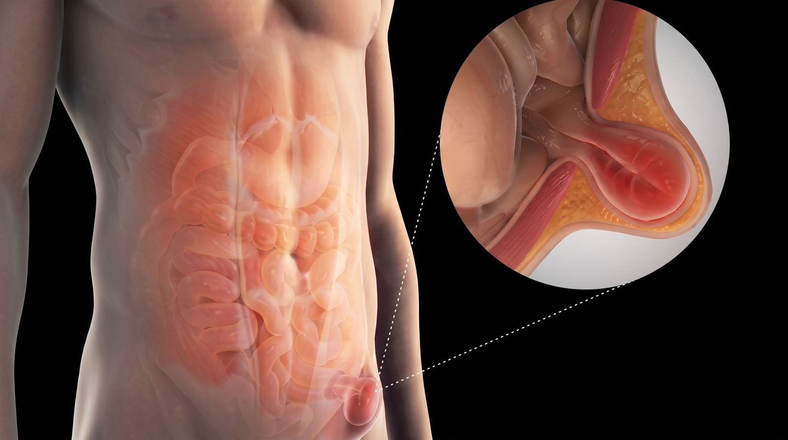 Hérnia Inguinal: Entenda as diferenças da conduta em homens e mulheres