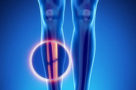Male bone anatomy fibula and tibia broken